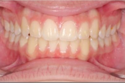 Case 11 after