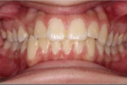 Case 11 before