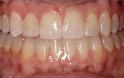 Case 14 after