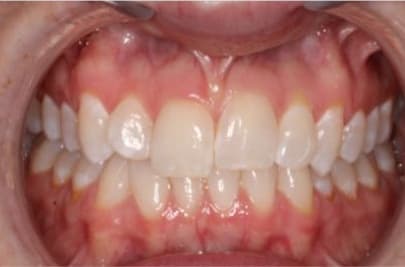 Case 14 before