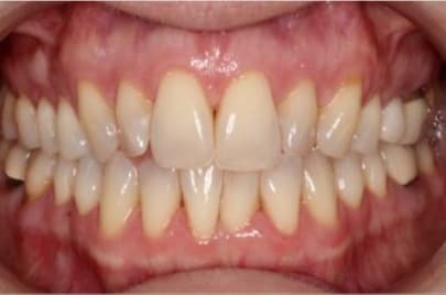 Case 15 before