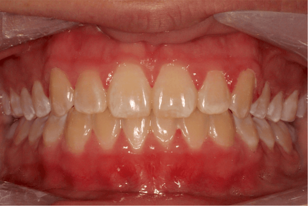 Case 6 after