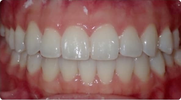 Case 11 after