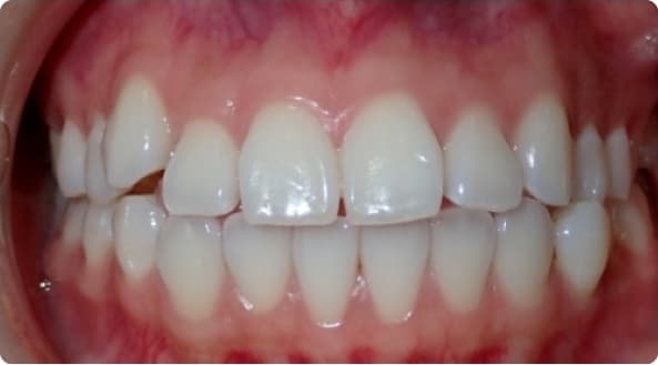 Case 11 before
