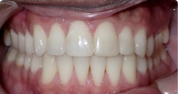 Case 13 after