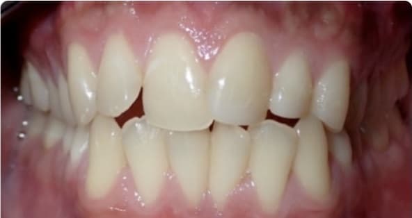Case 13 before