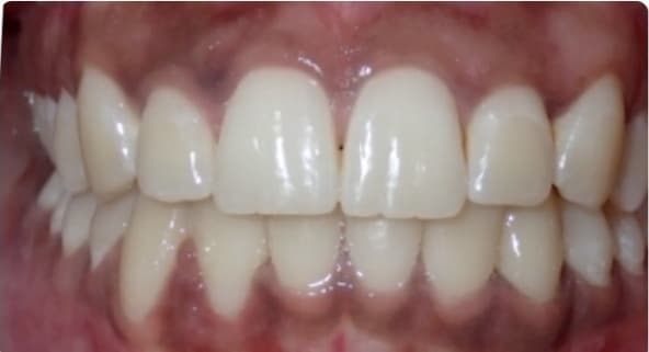 Case 14 after