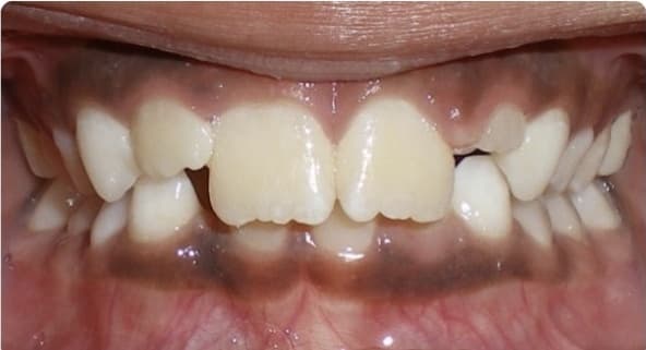 Case 14 before