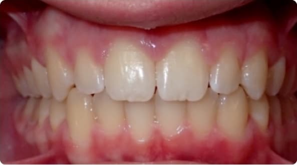 Case 17 after