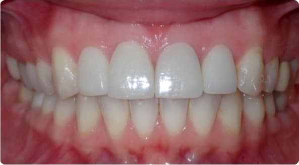 Case 21 after