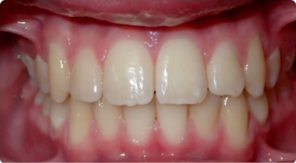 Case 22 after