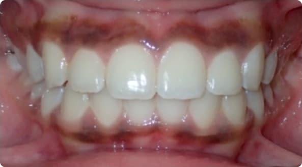 Case 23 after