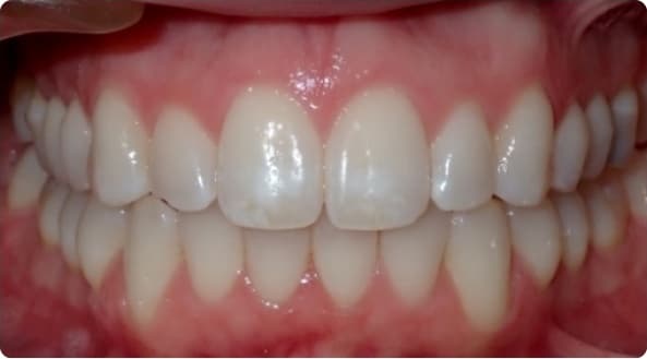 Case 25 after