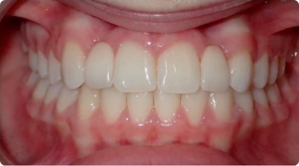 Case 26 after
