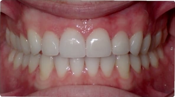 Case 29 after