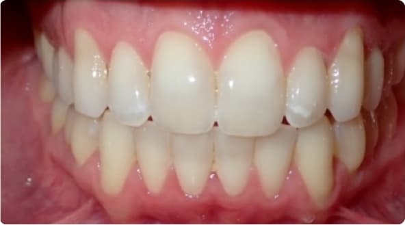 Case 30 after