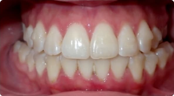 Case 31 after
