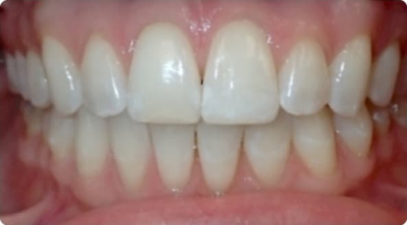 Case 4 after